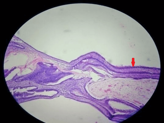 Mucinous Cystadenoma of Ovary