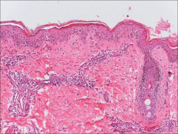 Acute GVHD