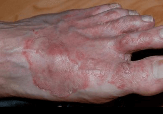 Dermatomycosis