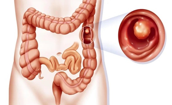 Intussusception