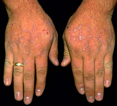  Lichen Planus