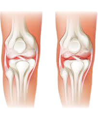 Osteophytes