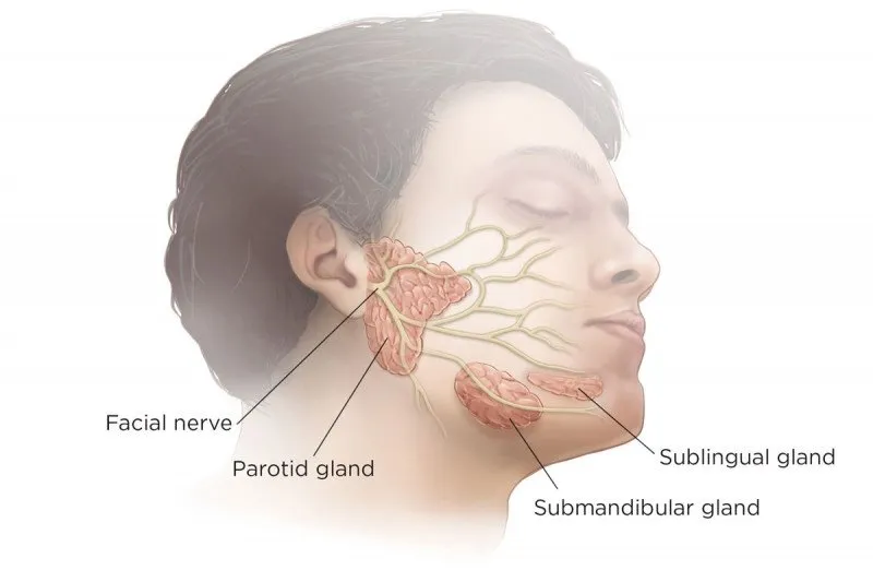 Parotitis