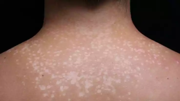 Pityriasis Versicolor