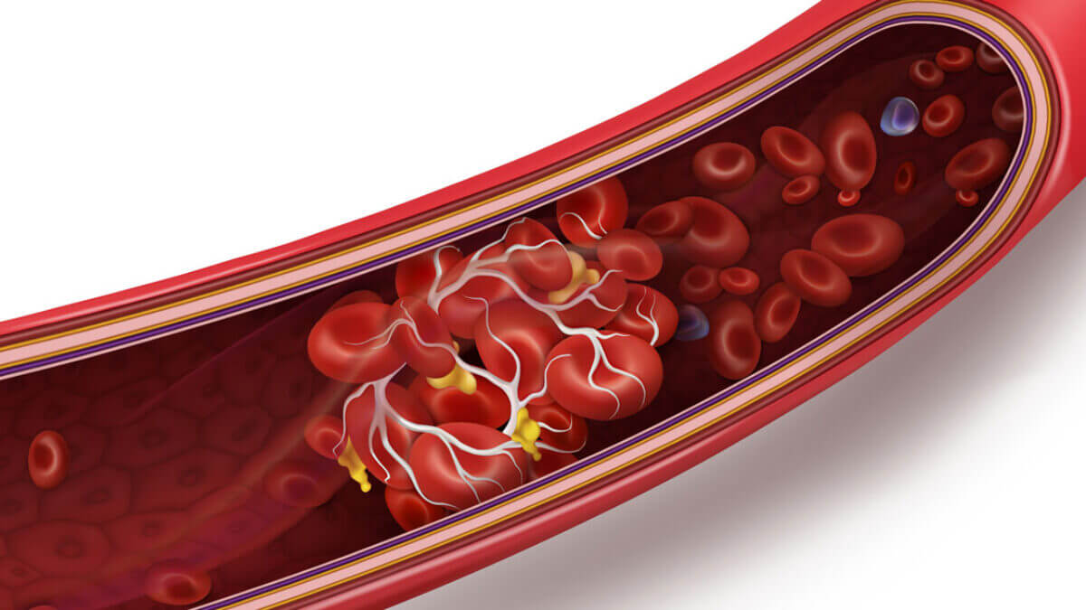 Thrombus