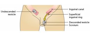 Undescended Testis
