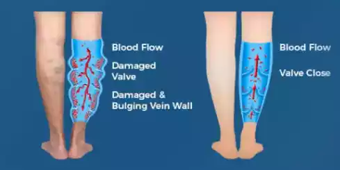 Varicose Veins