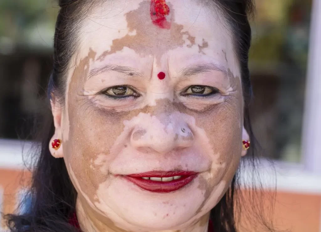 vitiligo